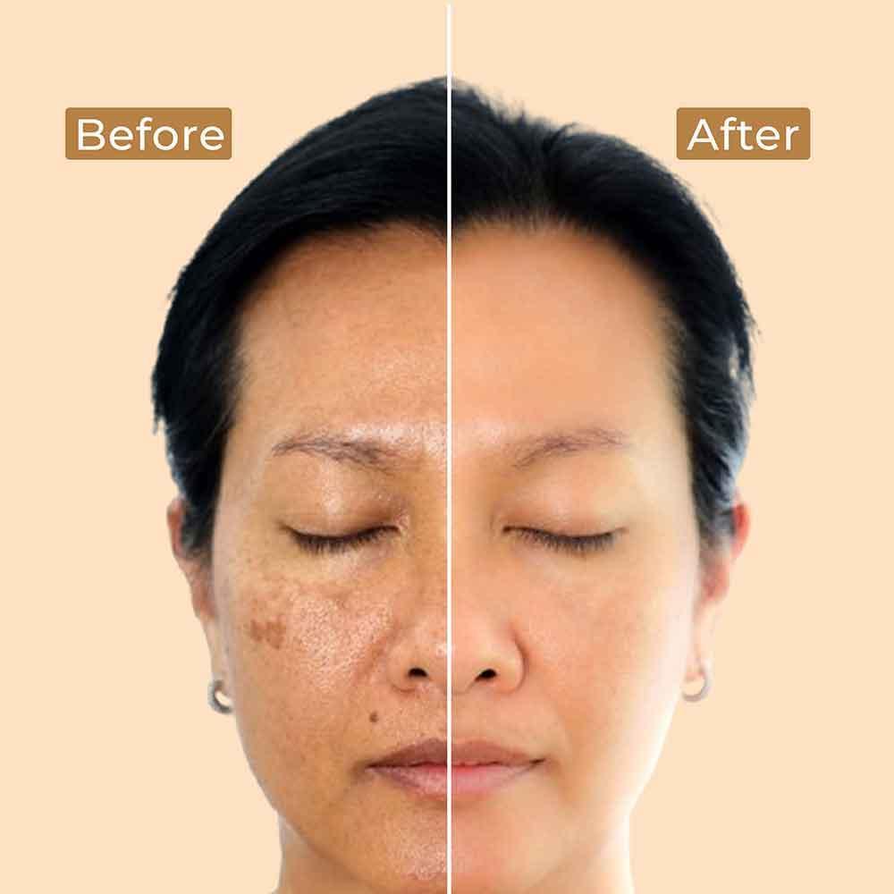 Complete Skin Pigmentation Regime - Image 2
